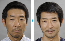 二重まぶた部分切開法（41歳）