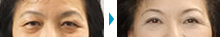 上まぶたのたるみ取り + 目の下のたるみ取り