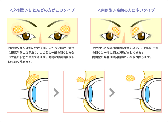 切らないアイリフト（上まぶた）＋脱脂 説明図