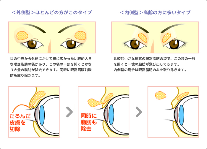 上まぶたのたるみ取り＋脱脂 説明図