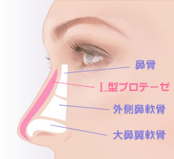 当院でL型プロテーゼを使用する場合